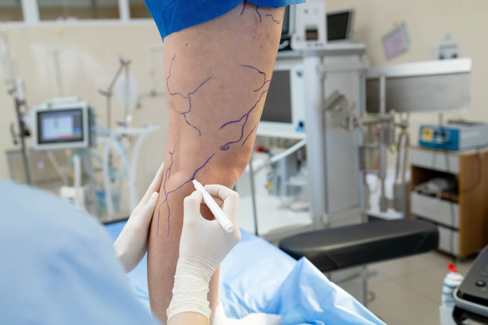 Консультация сосудистого хирурга