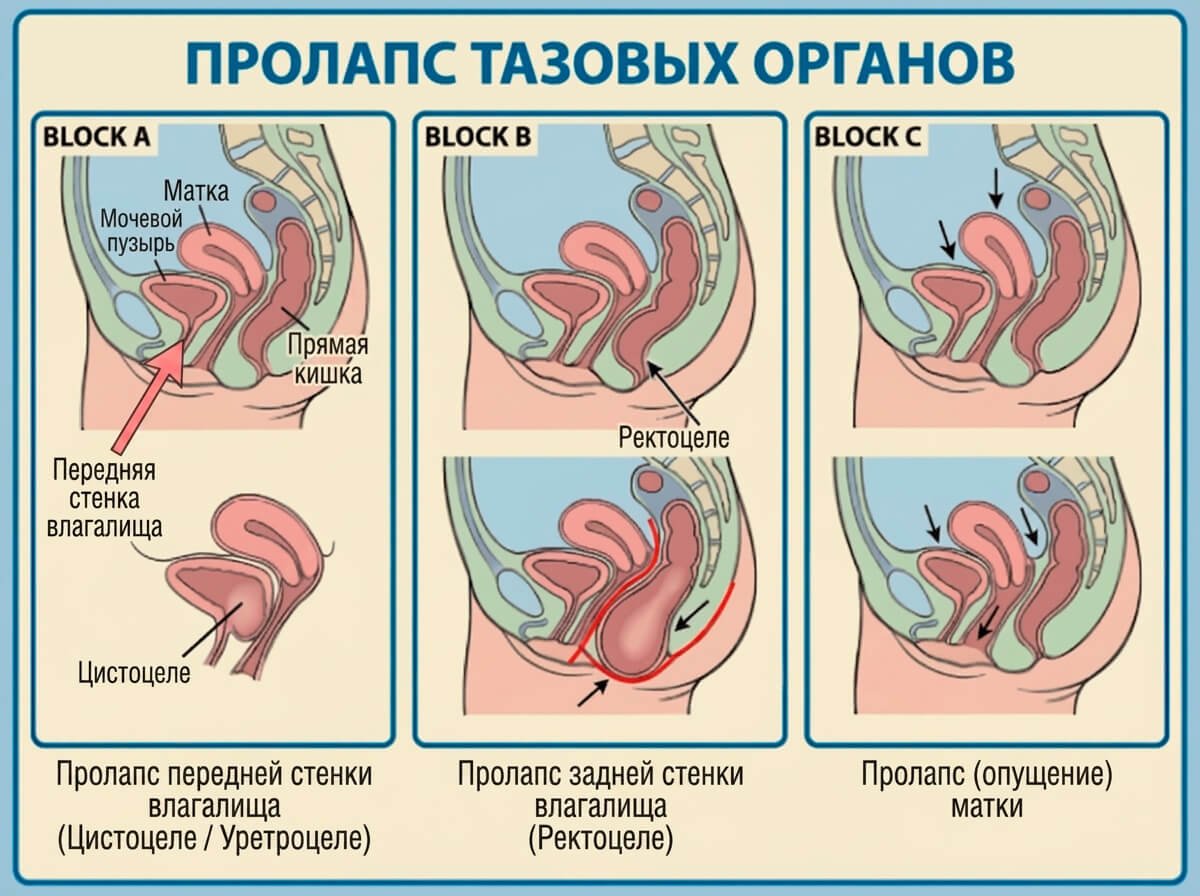 Пролапс тазовых органов