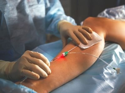 Эндовазальная лазерная коагуляция