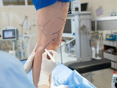 Консультация сосудистого хирурга